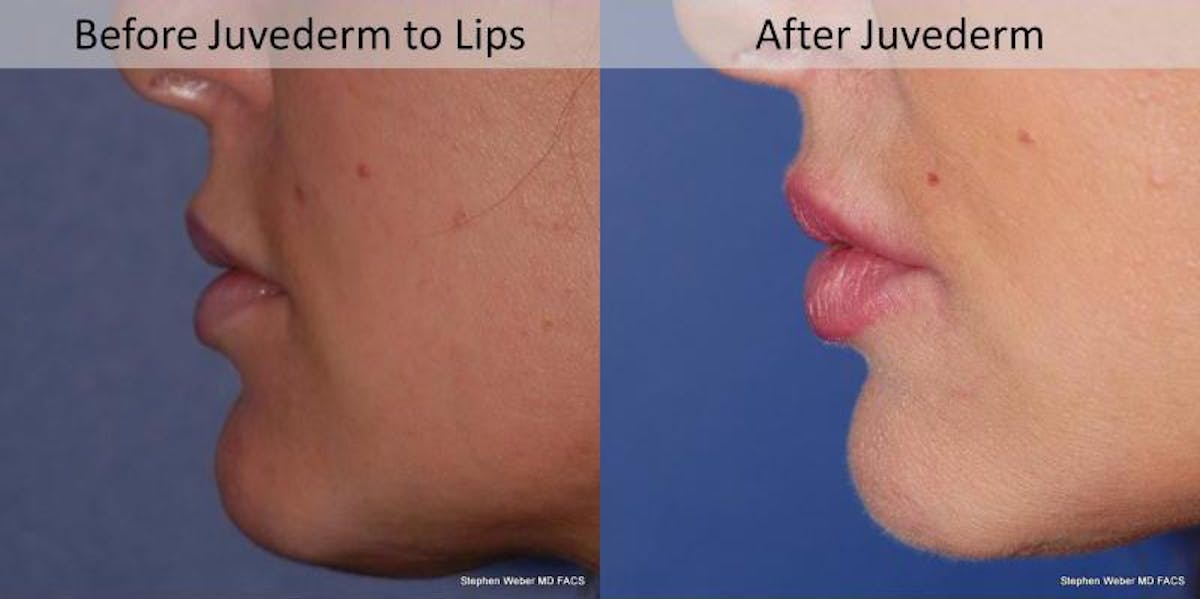 Dermal Filler Before & After Gallery - Patient 265819 - Image 2