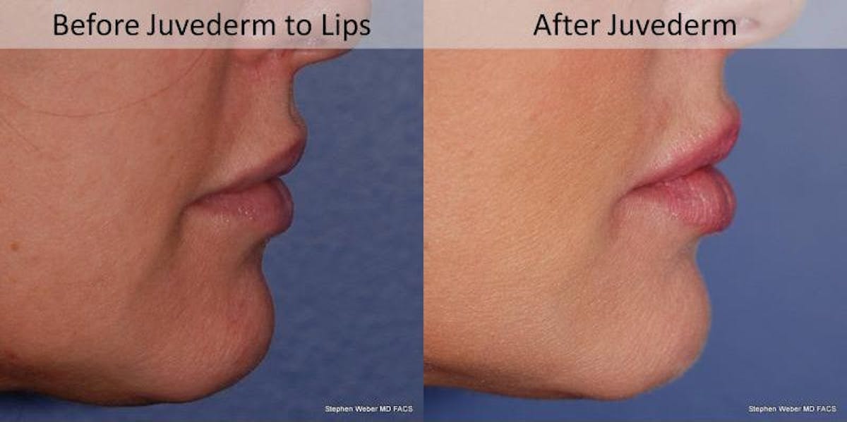 Dermal Filler Before & After Gallery - Patient 265819 - Image 3