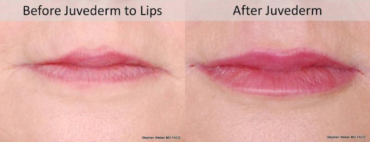 Dermal Filler Before & After Gallery - Patient 154244 - Image 1