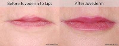 Dermal Filler Before & After Gallery - Patient 154244 - Image 1