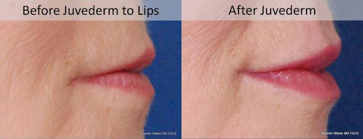 Dermal Filler Before & After Gallery - Patient 154244 - Image 2