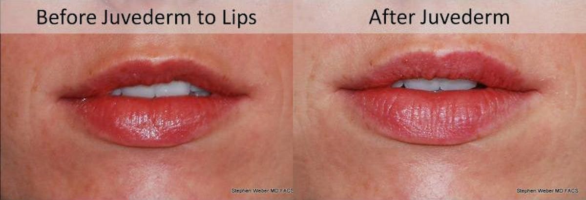 Dermal Filler Before & After Gallery - Patient 384031 - Image 1