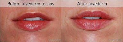 Dermal Filler Before & After Gallery - Patient 384031 - Image 1