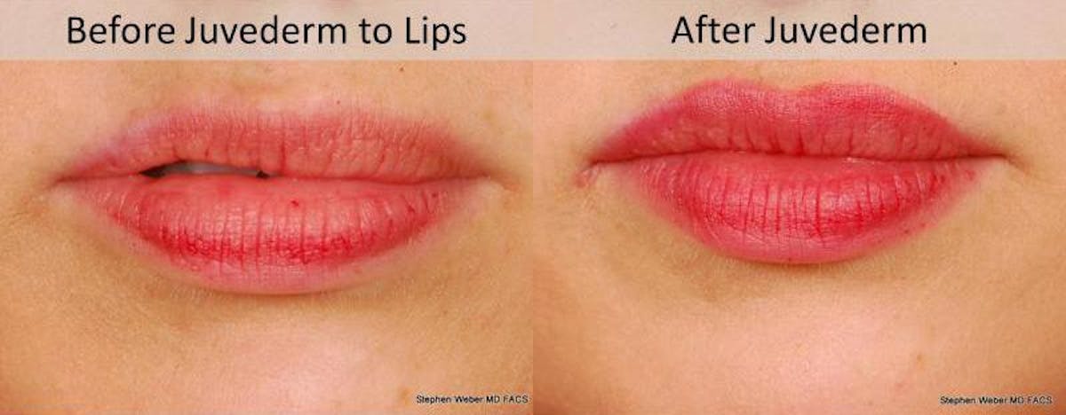 Dermal Filler Before & After Gallery - Patient 224833 - Image 1
