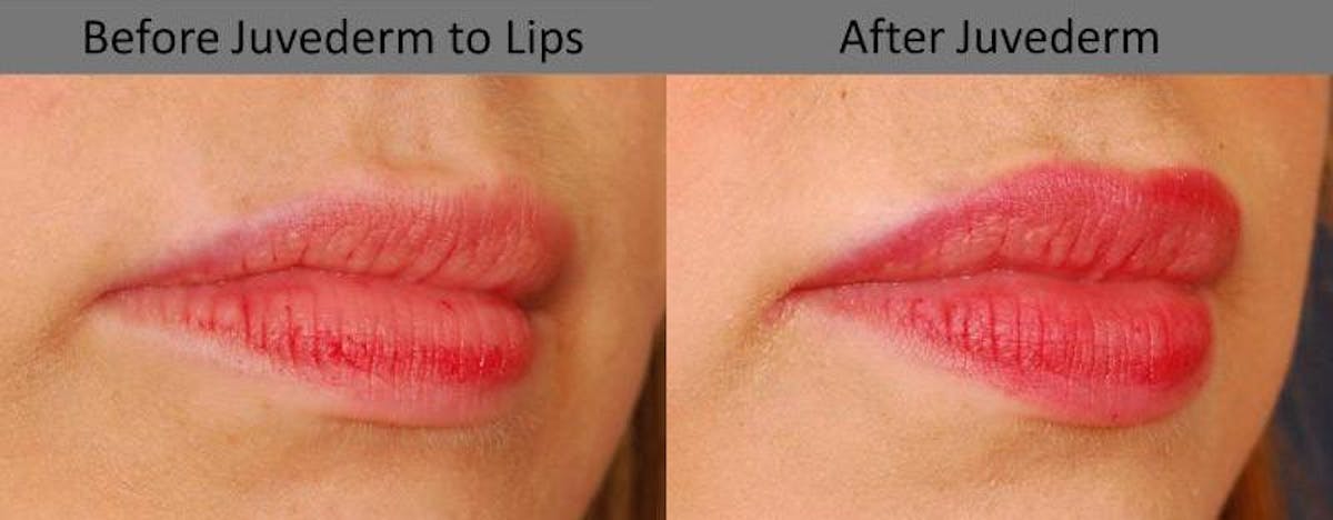 Dermal Filler Before & After Gallery - Patient 224833 - Image 2