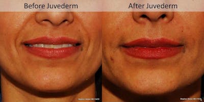 Dermal Filler Before & After Gallery - Patient 124144 - Image 1