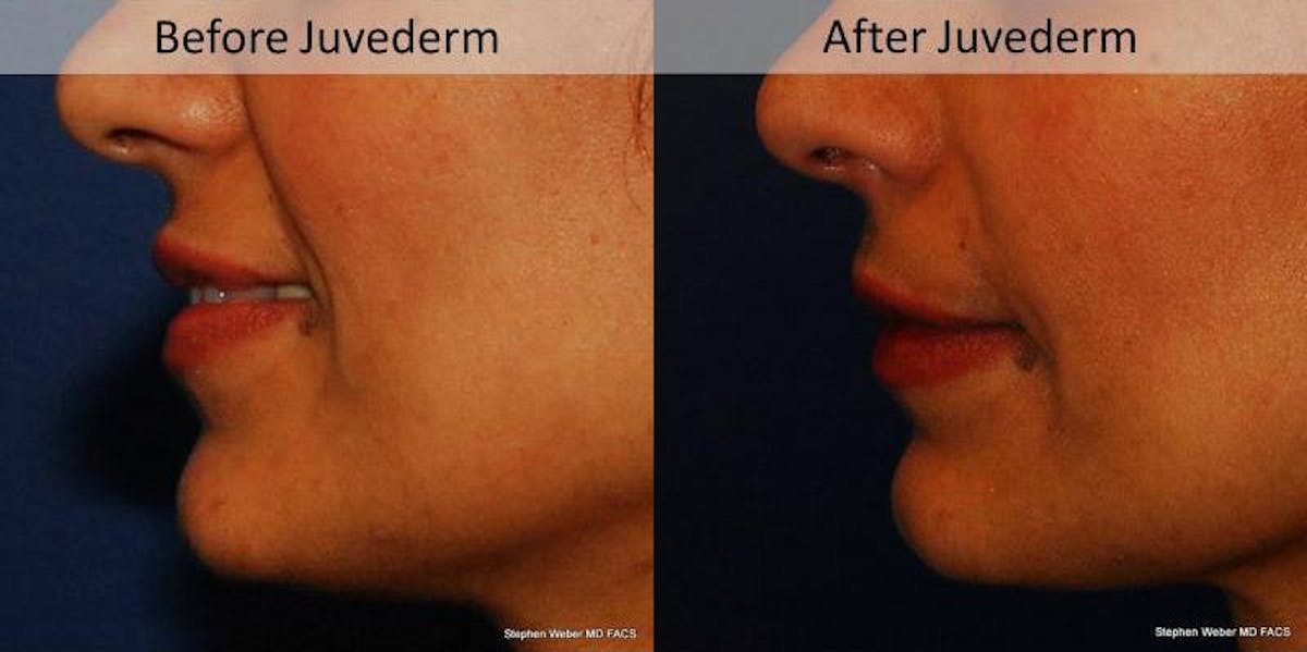 Dermal Filler Before & After Gallery - Patient 124144 - Image 3