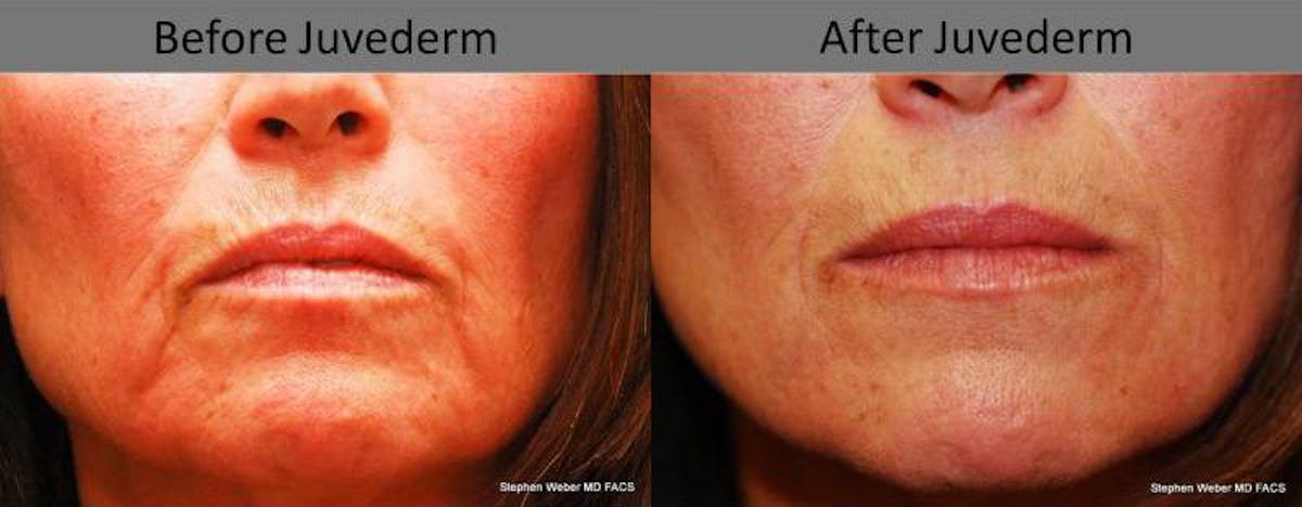 Dermal Filler Before & After Gallery - Patient 213475 - Image 1