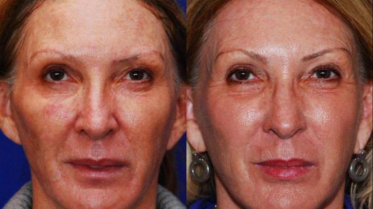Dermal Filler Before & After Gallery - Patient 224626 - Image 1