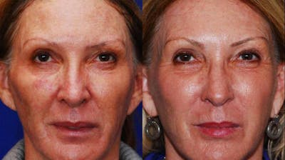 Dermal Filler Before & After Gallery - Patient 224626 - Image 1