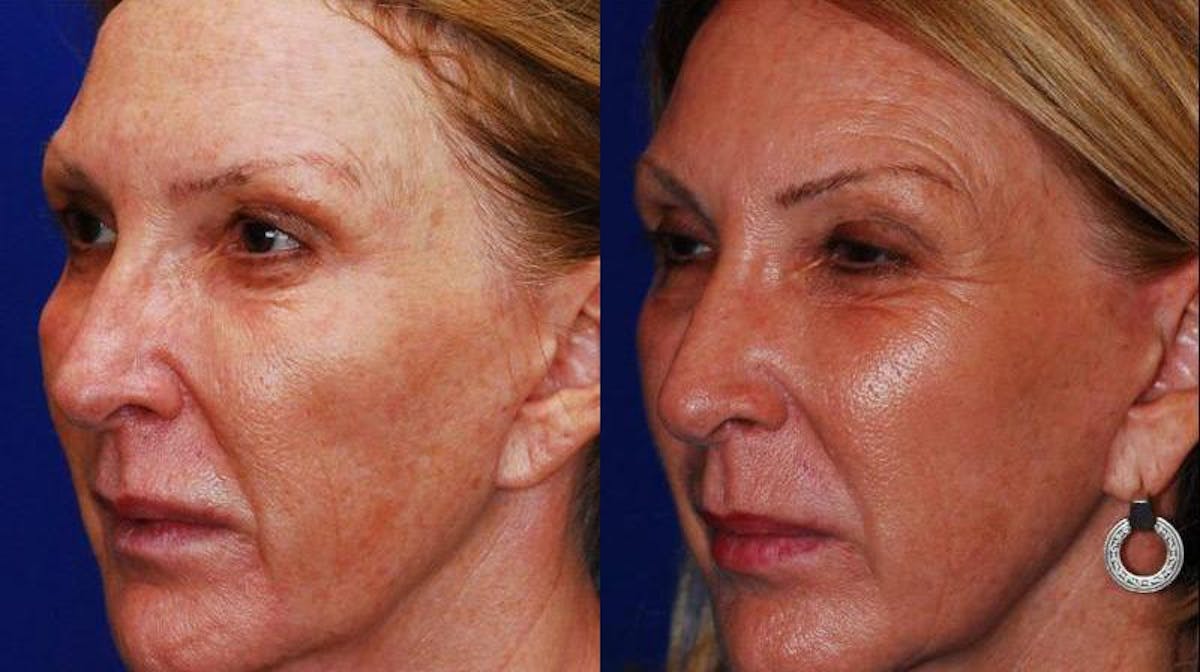 Dermal Filler Before & After Gallery - Patient 224626 - Image 2