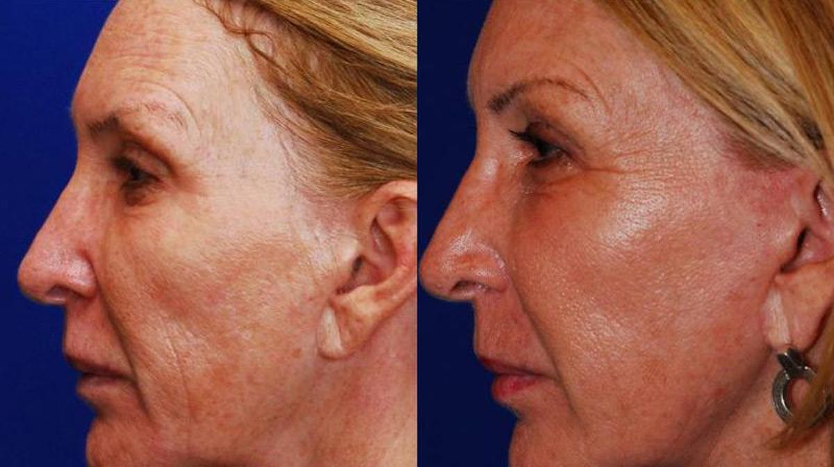 Dermal Filler Before & After Gallery - Patient 224626 - Image 3