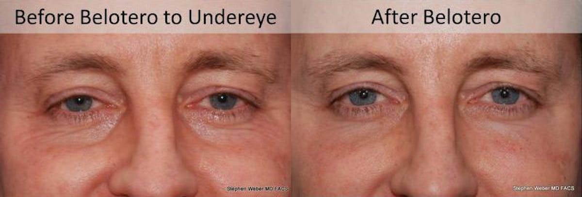 Dermal Filler Before & After Gallery - Patient 512440 - Image 1