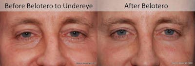 Dermal Filler Before & After Gallery - Patient 512440 - Image 1