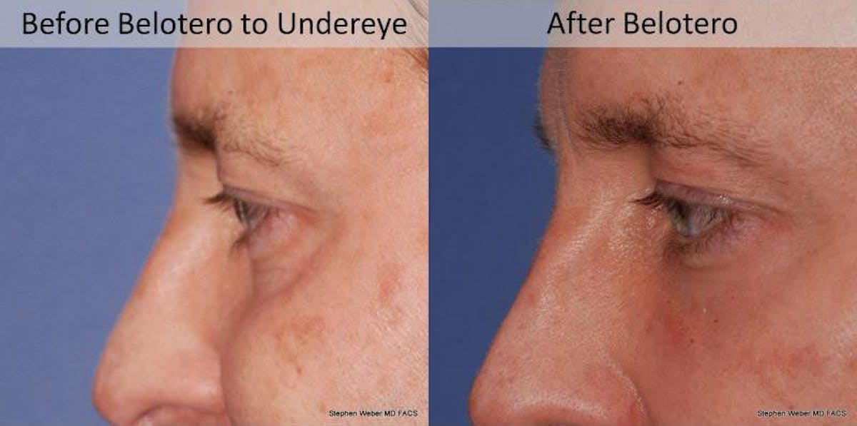 Dermal Filler Before & After Gallery - Patient 512440 - Image 2