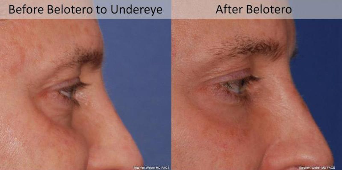 Dermal Filler Before & After Gallery - Patient 512440 - Image 3