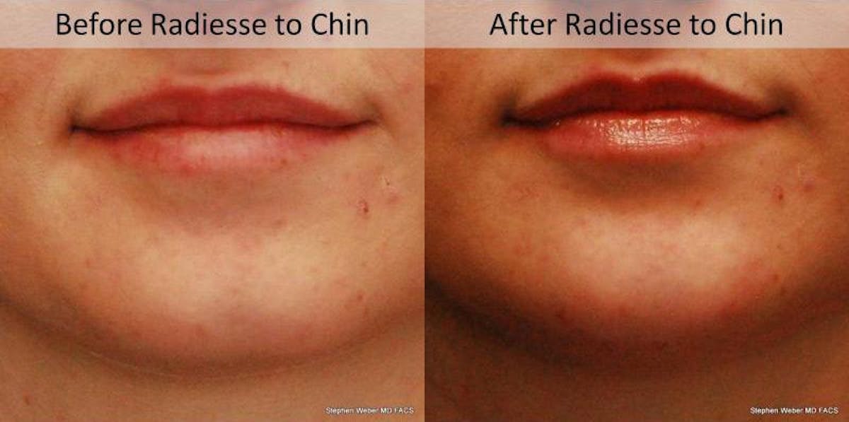 Dermal Filler Before & After Gallery - Patient 838853 - Image 1