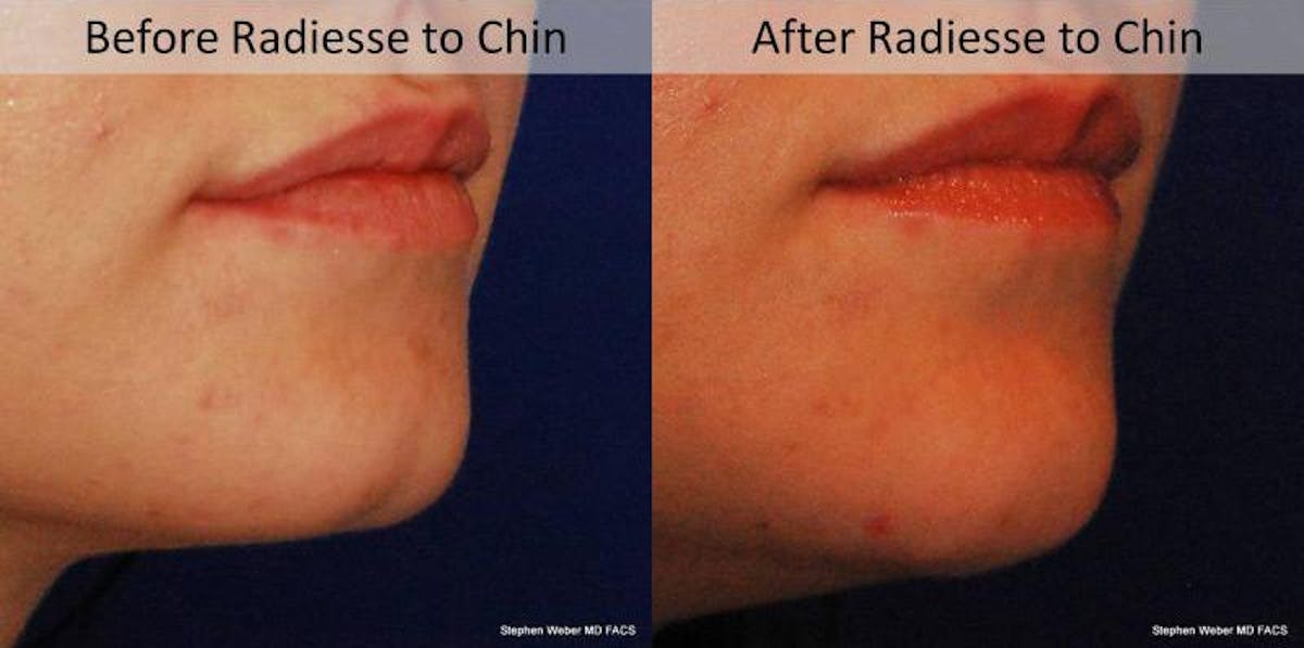 Dermal Filler Before & After Gallery - Patient 838853 - Image 2
