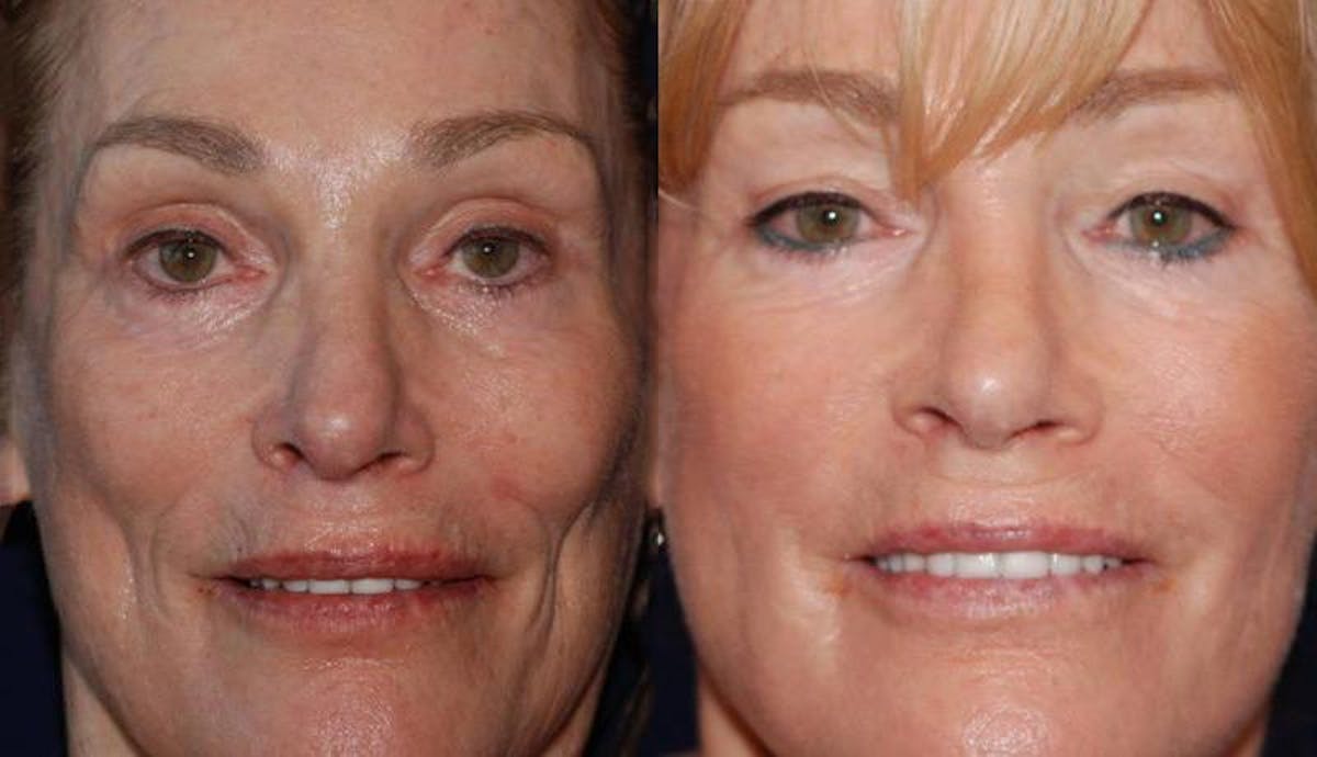 Dermal Filler Before & After Gallery - Patient 419865 - Image 1
