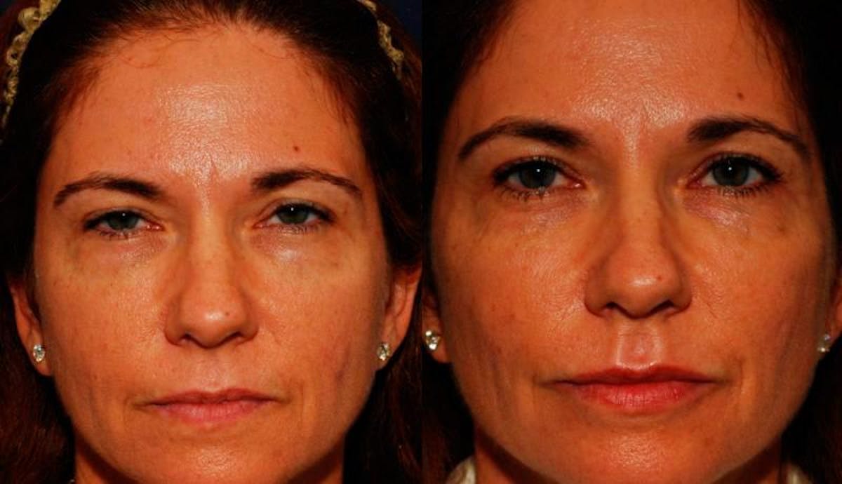 Dermal Filler Before & After Gallery - Patient 291937 - Image 1