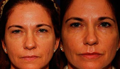 Dermal Filler Before & After Gallery - Patient 291937 - Image 1