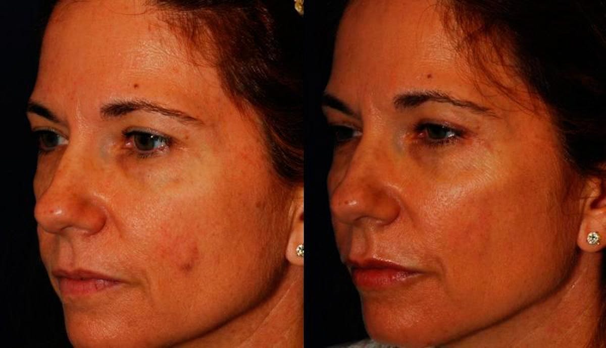 Dermal Filler Before & After Gallery - Patient 291937 - Image 2