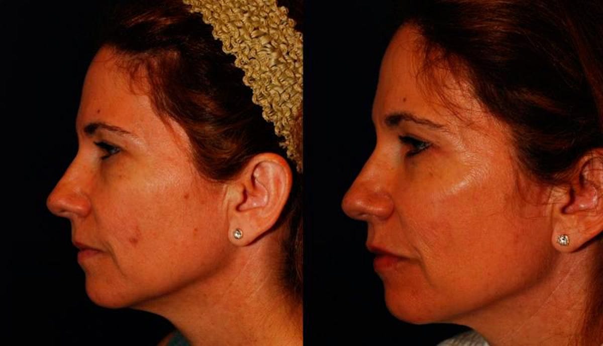 Dermal Filler Before & After Gallery - Patient 291937 - Image 3