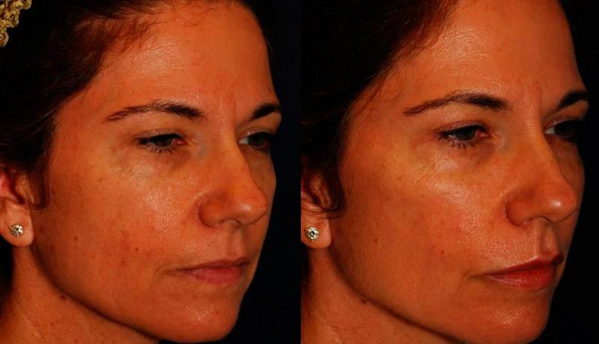 Dermal Filler Before & After Gallery - Patient 291937 - Image 4