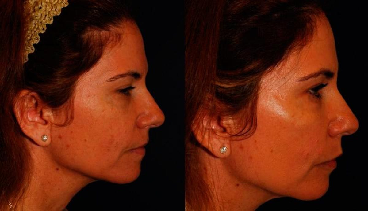 Dermal Filler Before & After Gallery - Patient 291937 - Image 5