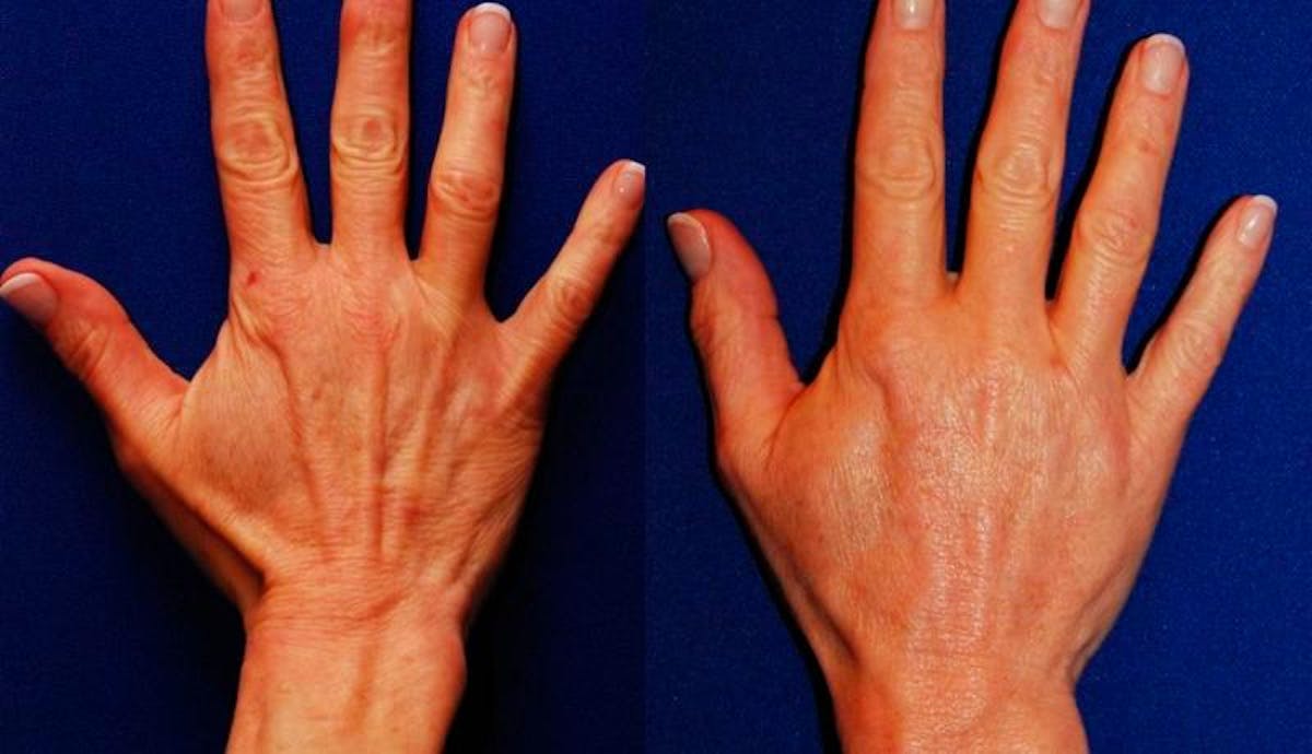 Dermal Filler Before & After Gallery - Patient 192867 - Image 1