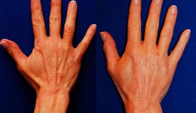 Dermal Filler Before & After Gallery - Patient 192867 - Image 1