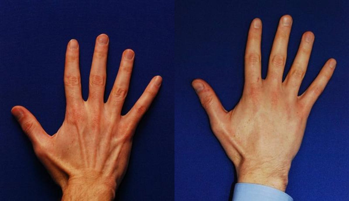 Dermal Filler Before & After Gallery - Patient 129628 - Image 1