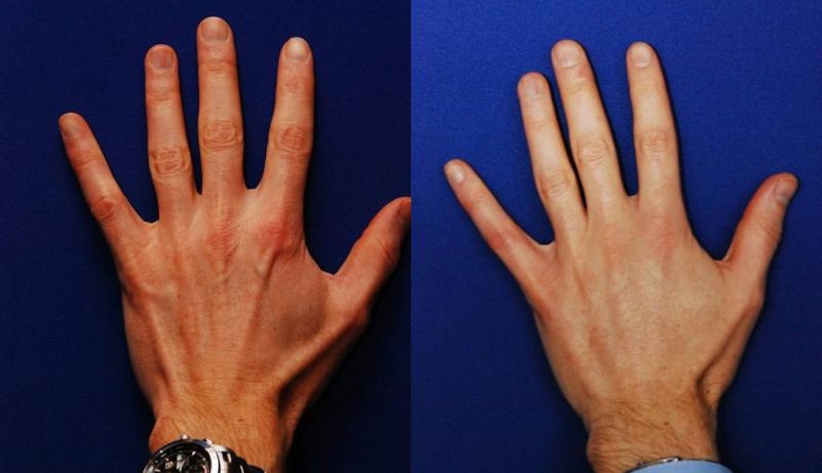 Dermal Filler Before & After Gallery - Patient 129628 - Image 2