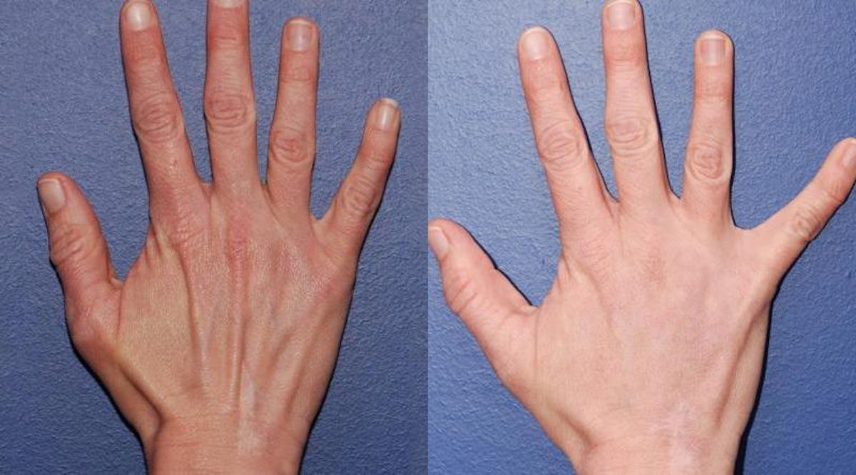 Dermal Filler Before & After Gallery - Patient 881106 - Image 1