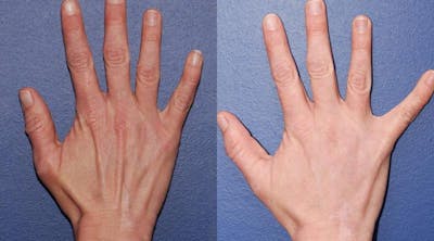 Dermal Filler Before & After Gallery - Patient 881106 - Image 1