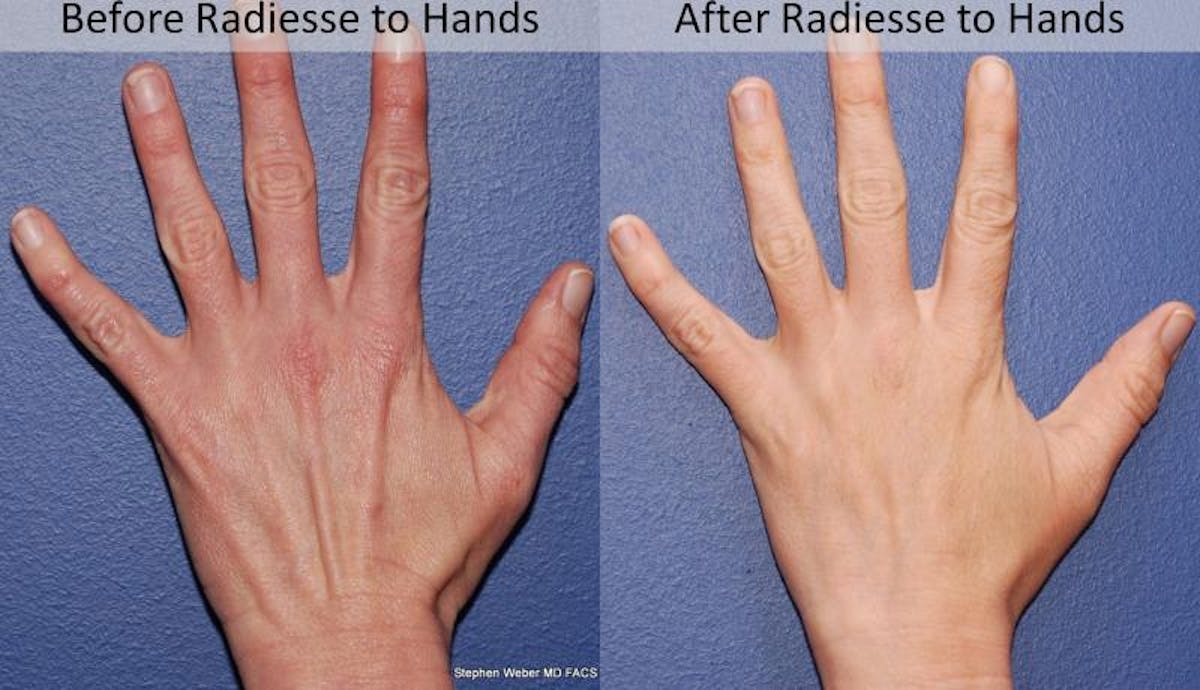 Dermal Filler Before & After Gallery - Patient 881106 - Image 2