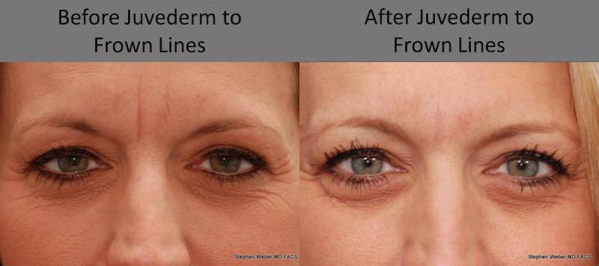 Dermal Filler Before & After Gallery - Patient 205258 - Image 1