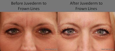 Dermal Filler Before & After Gallery - Patient 205258 - Image 1