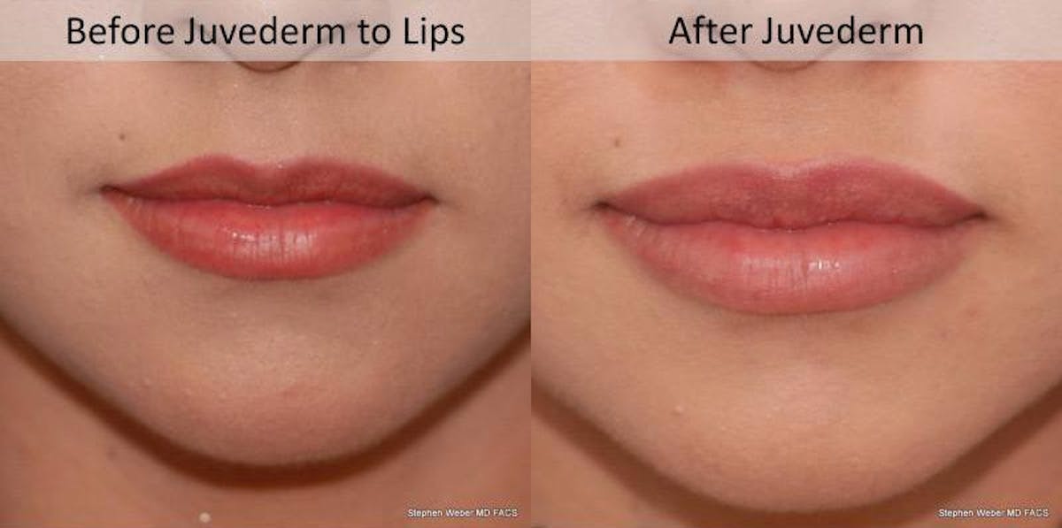 Dermal Filler Before & After Gallery - Patient 674736 - Image 1