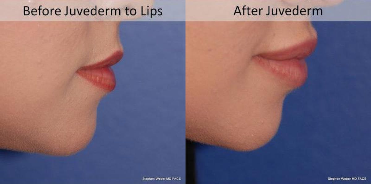 Dermal Filler Before & After Gallery - Patient 674736 - Image 2