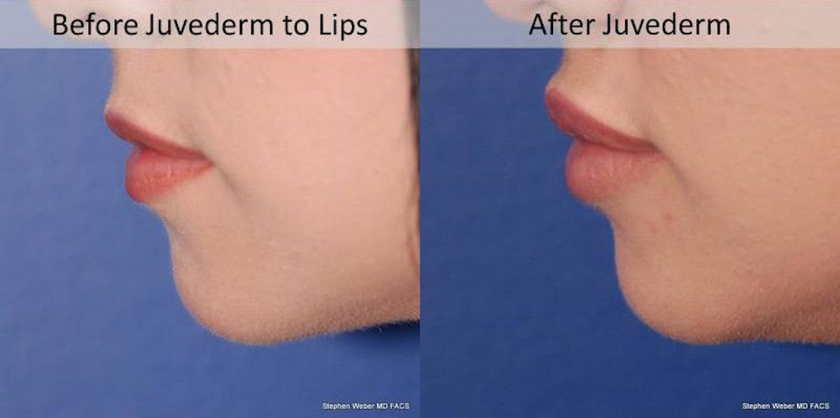 Dermal Filler Before & After Gallery - Patient 674736 - Image 3