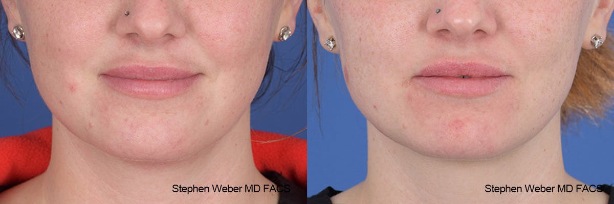 Kybella Before & After Gallery - Patient 112129 - Image 1