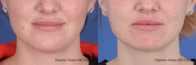 Kybella Before & After Gallery - Patient 112129 - Image 1
