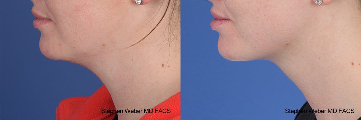 Kybella Before & After Gallery - Patient 112129 - Image 2