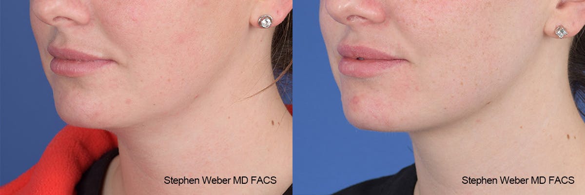 Kybella Before & After Gallery - Patient 112129 - Image 3