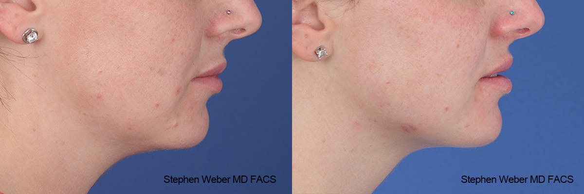 Kybella Before & After Gallery - Patient 112129 - Image 4