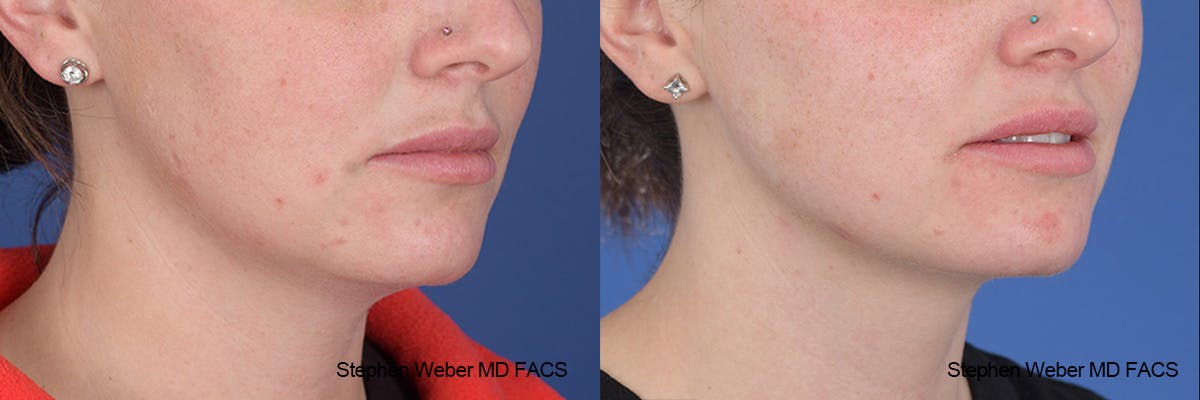 Kybella Before & After Gallery - Patient 112129 - Image 5