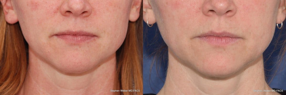 Kybella Before & After Gallery - Patient 360672 - Image 1