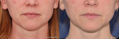 Kybella Before & After Gallery - Patient 360672 - Image 1