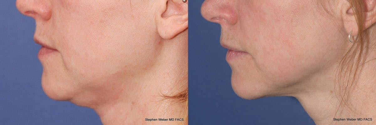 Kybella Before & After Gallery - Patient 360672 - Image 2